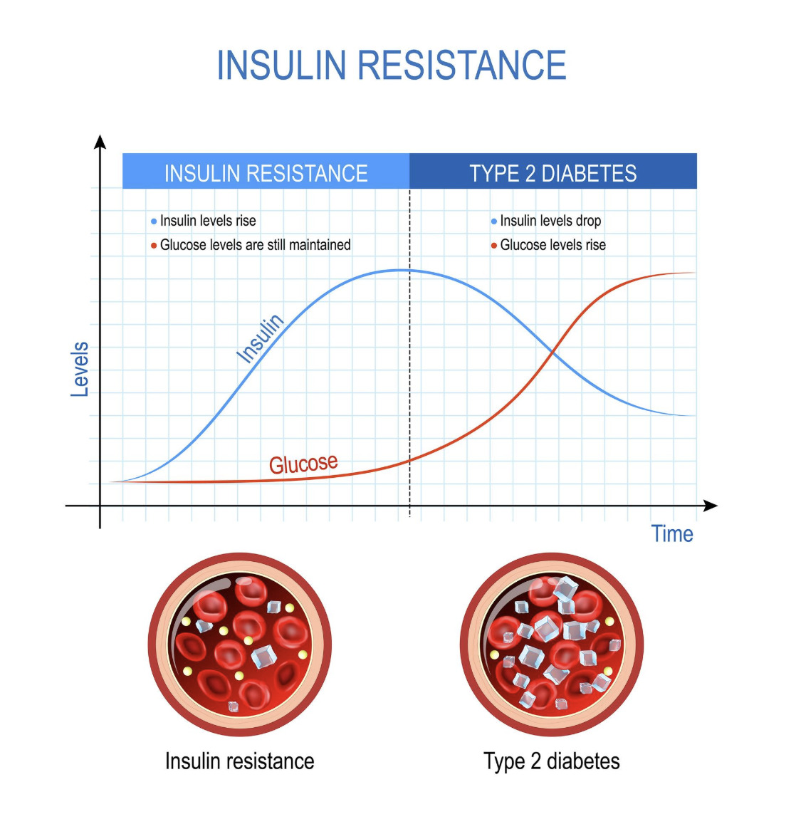 Type 2 Diabetes Symptoms Causes and Treatment Explained